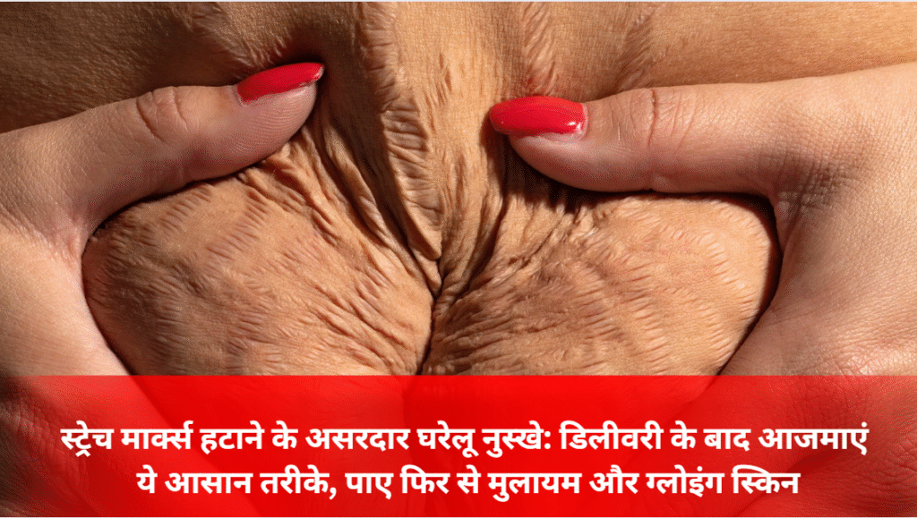 स्ट्रेच मार्क्स हटाने के असरदार घरेलू नुस्खे: डिलीवरी के बाद आजमाएं ये आसान तरीके, पाए फिर से मुलायम और ग्लोइंग स्किन