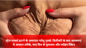 स्ट्रेच मार्क्स हटाने के असरदार घरेलू नुस्खे: डिलीवरी के बाद आजमाएं ये आसान तरीके, पाए फिर से मुलायम और ग्लोइंग स्किन